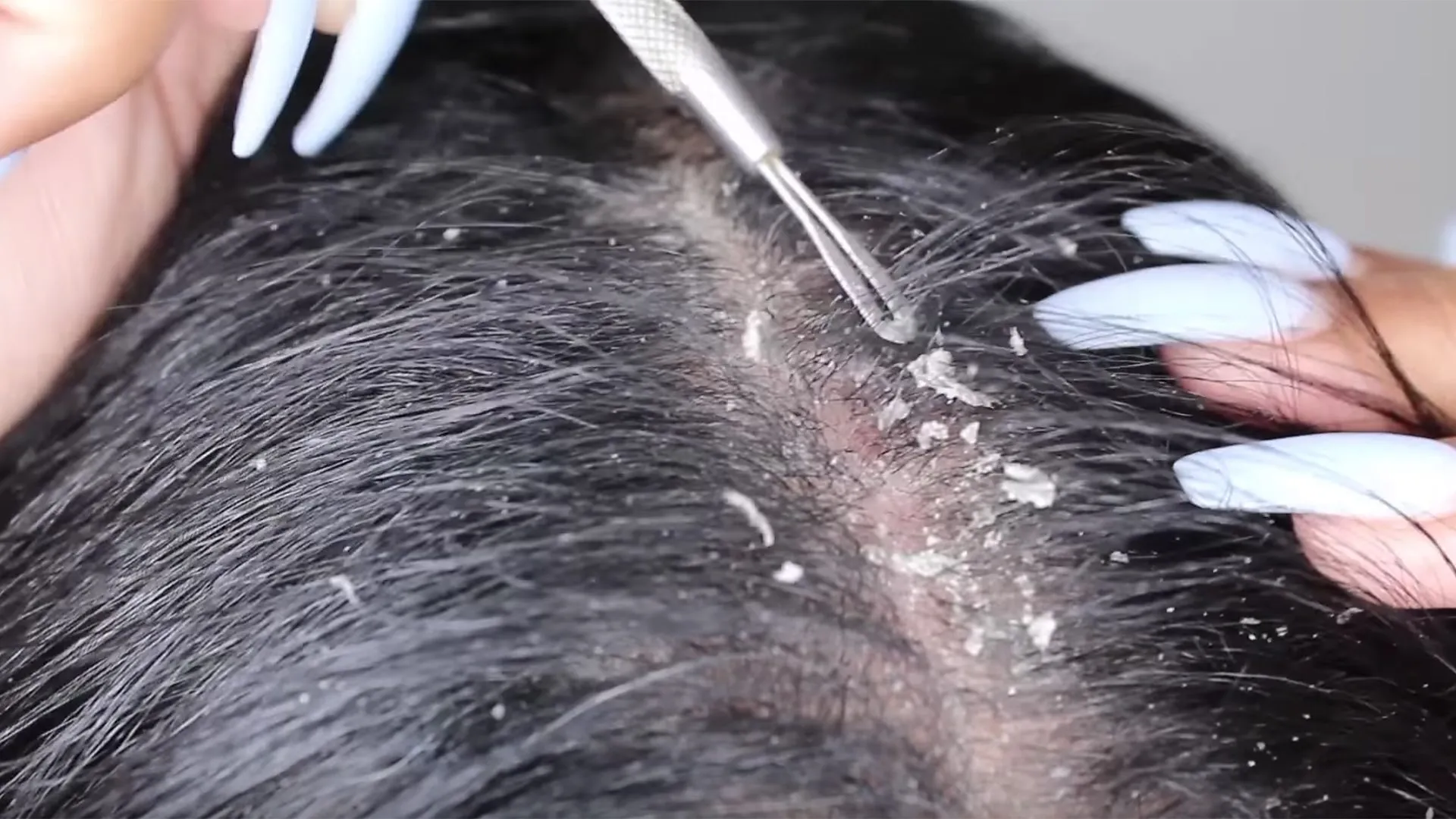 Struggling with dandruff? Get effective, long-last...