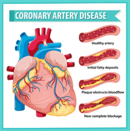 Coronary Artery Disease Treatment in Chennai SR He...