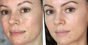 IPL Anti Aging Facial at Pitampura
IPL Anti Agin...