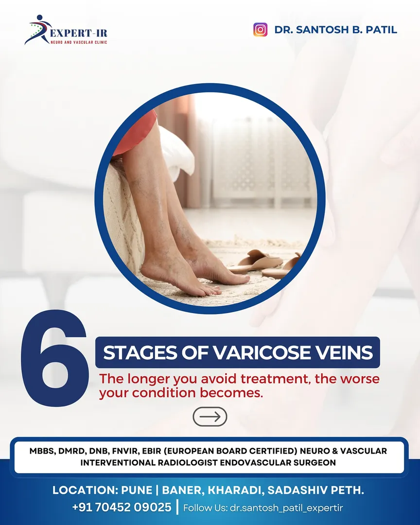 Varicose veins generally progress through several ...