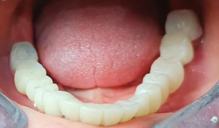 Temporary bridge given to the patient on 3 teeth t...