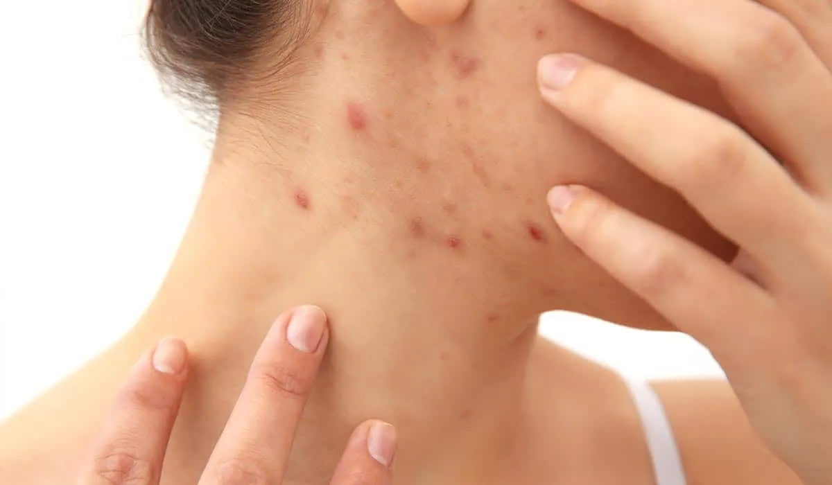 Acne During Pregnancy: Causes, Precautions, and Tr...