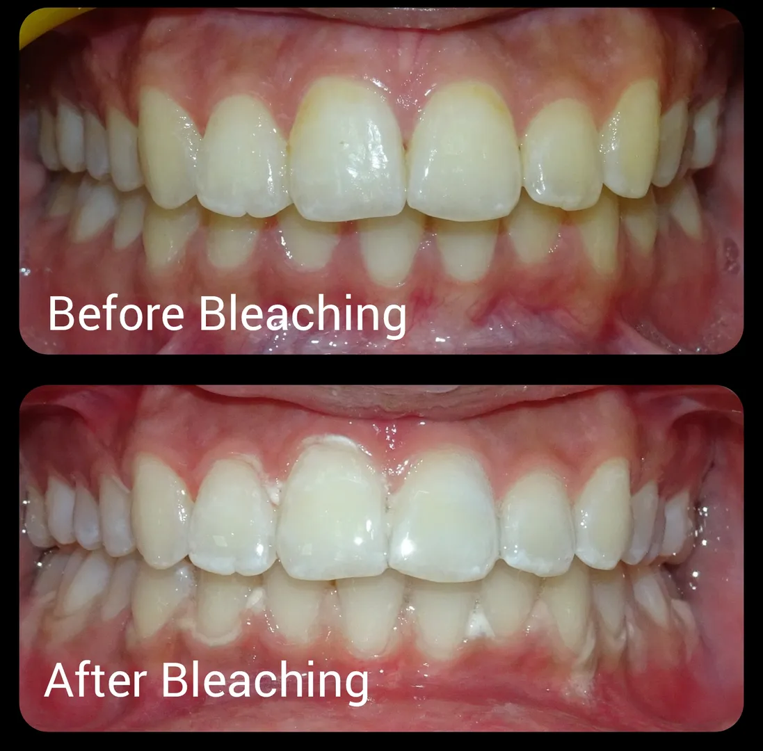 Bleaching or tooth whitening is a simple procedure...