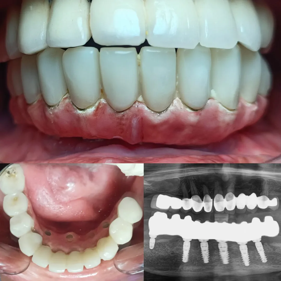 Dental implants in irradiated bone.
Yes it is poss...