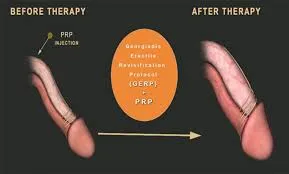 Platelet Rich Plasma for Male Erectile Dysfunction...