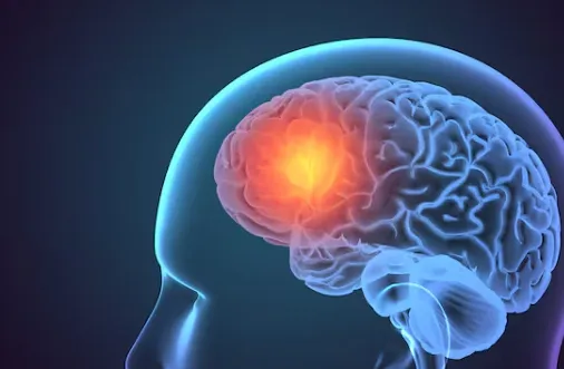 Advanced Brain Stroke Care in Pune - Restoring Hea...