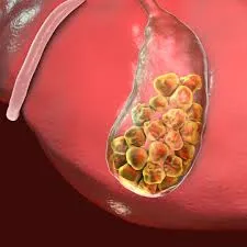 # Gallstones treatment in chembur
# Gallstones sur...