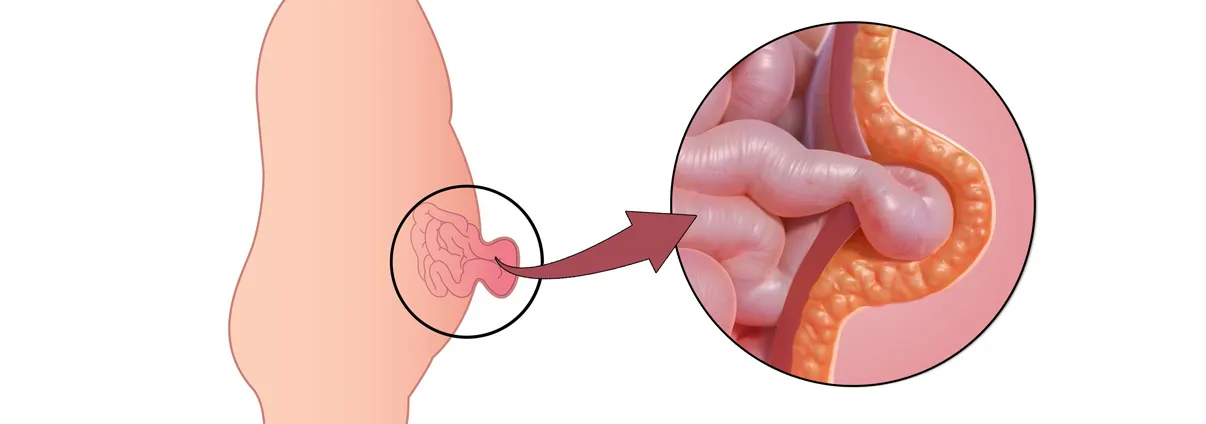 # Hernia Surgery in chembur
# Hernia Surgery in ti...