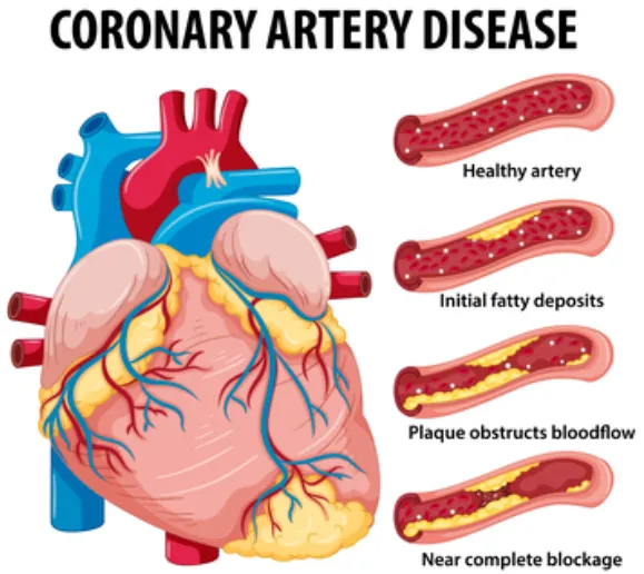 Expert Treatment for Coronary Artery Disease in Ch...