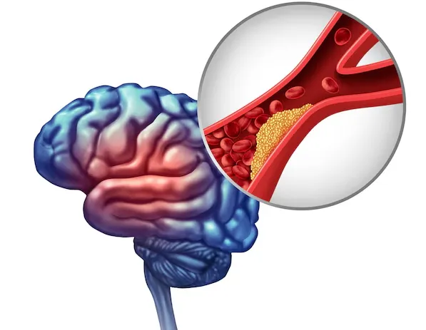 Brain Aneurysm Repair in Pune – Advanced Surgical ...
