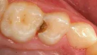 WHY TOOTH COLOR FILLING TURNS YELLOW WITH TIME
(...