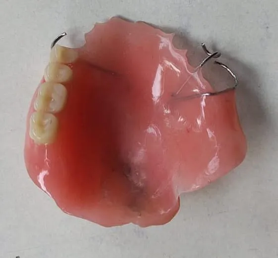 Dentures or obturators for post cancer patients
...