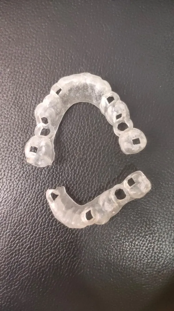 Guided Dental implant surgery at Procare dental cl...