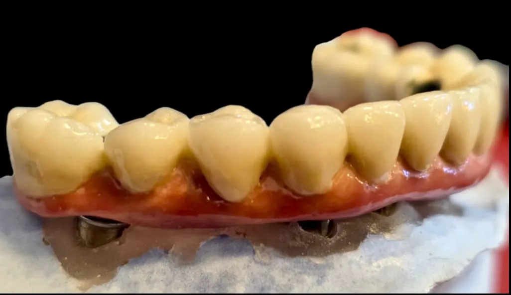 All Fixed Teeth on Implants
Missing teeth, repla...