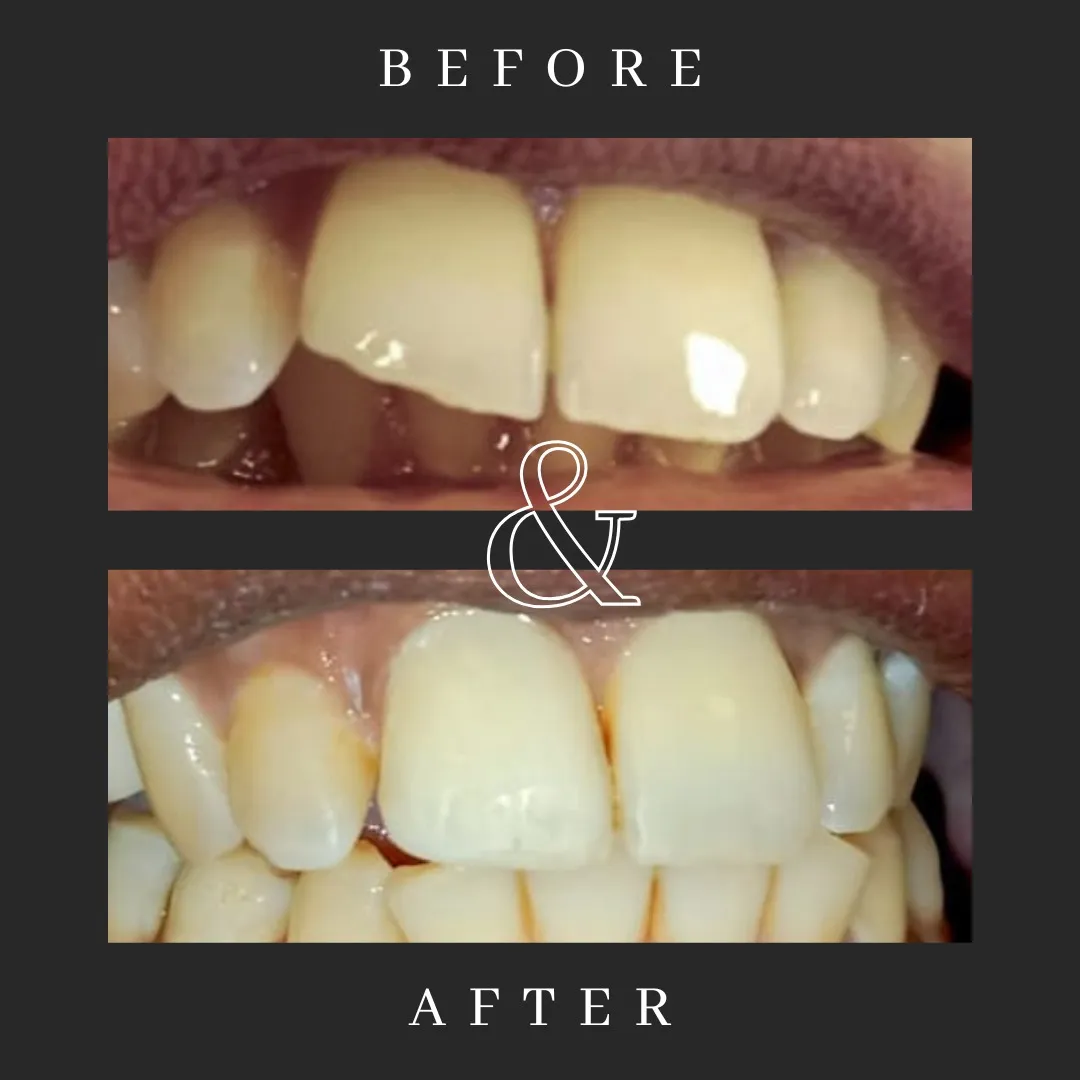 Bonding and composite build-up
Have you fracture...