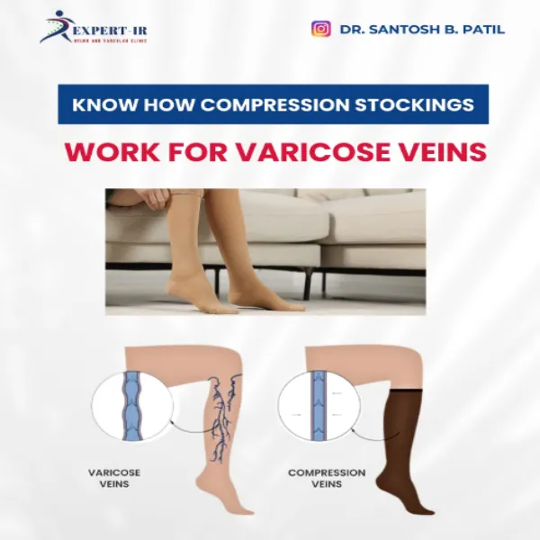 Best Varicose Veins Treatment in Pune ! Compressio...