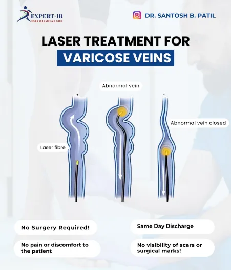 LASER TREATMENT FOR VARICOSE VEINS has helped thou...