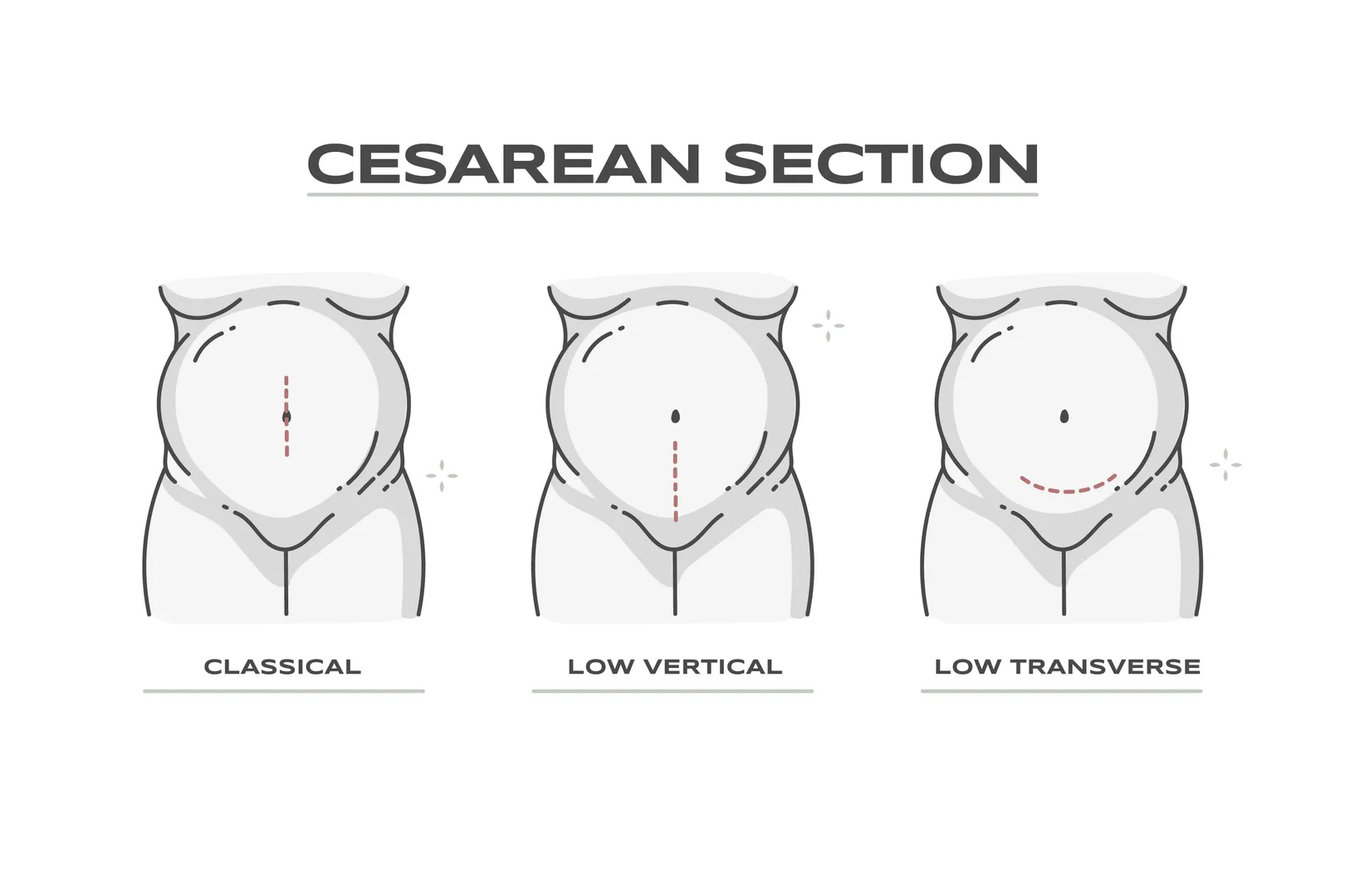 Cesarean Section in Mumbai Safe and Expert Deliver...