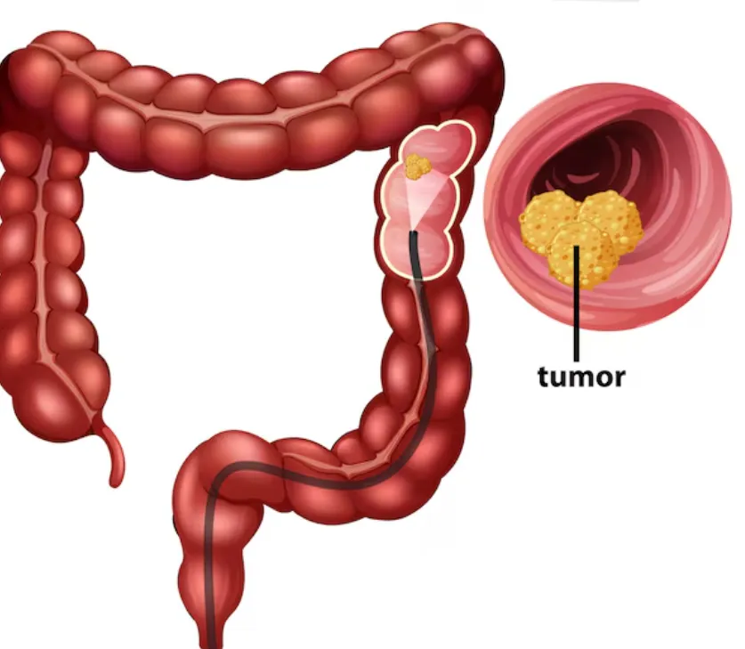 Best Colon Cancer Screening in Mumbai Colon cancer...