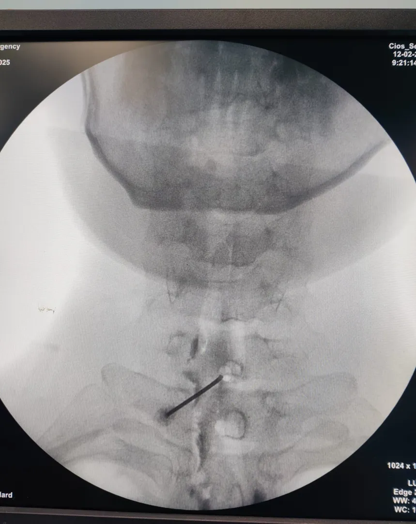 When to Consider a Cervical Epidural Injection?
Ce...
