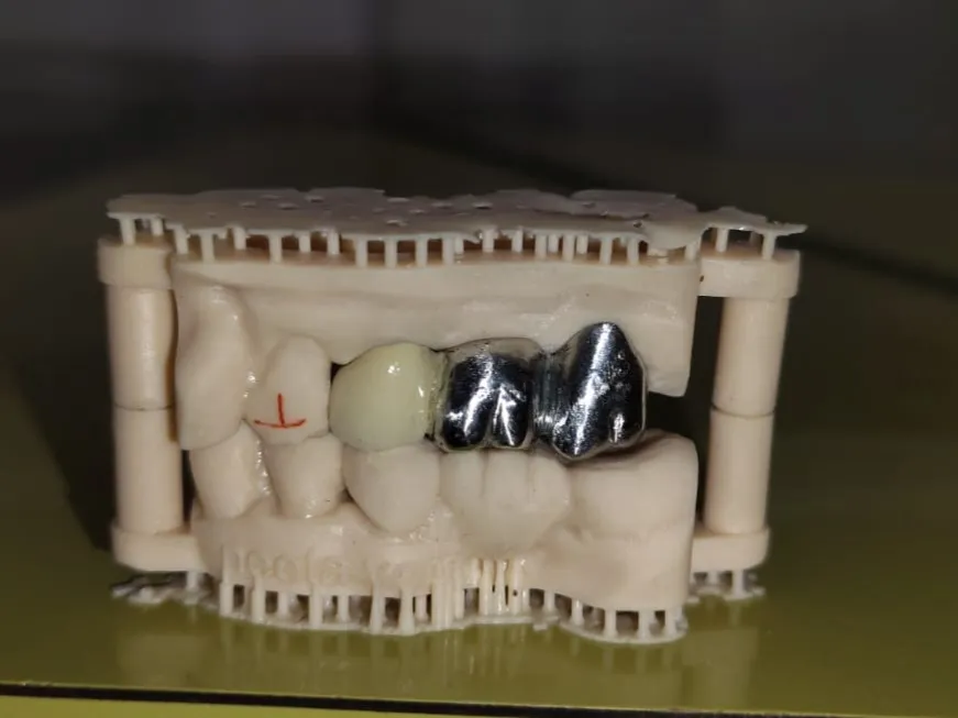 Metal and ceramic bridge combination. Digitally ma...