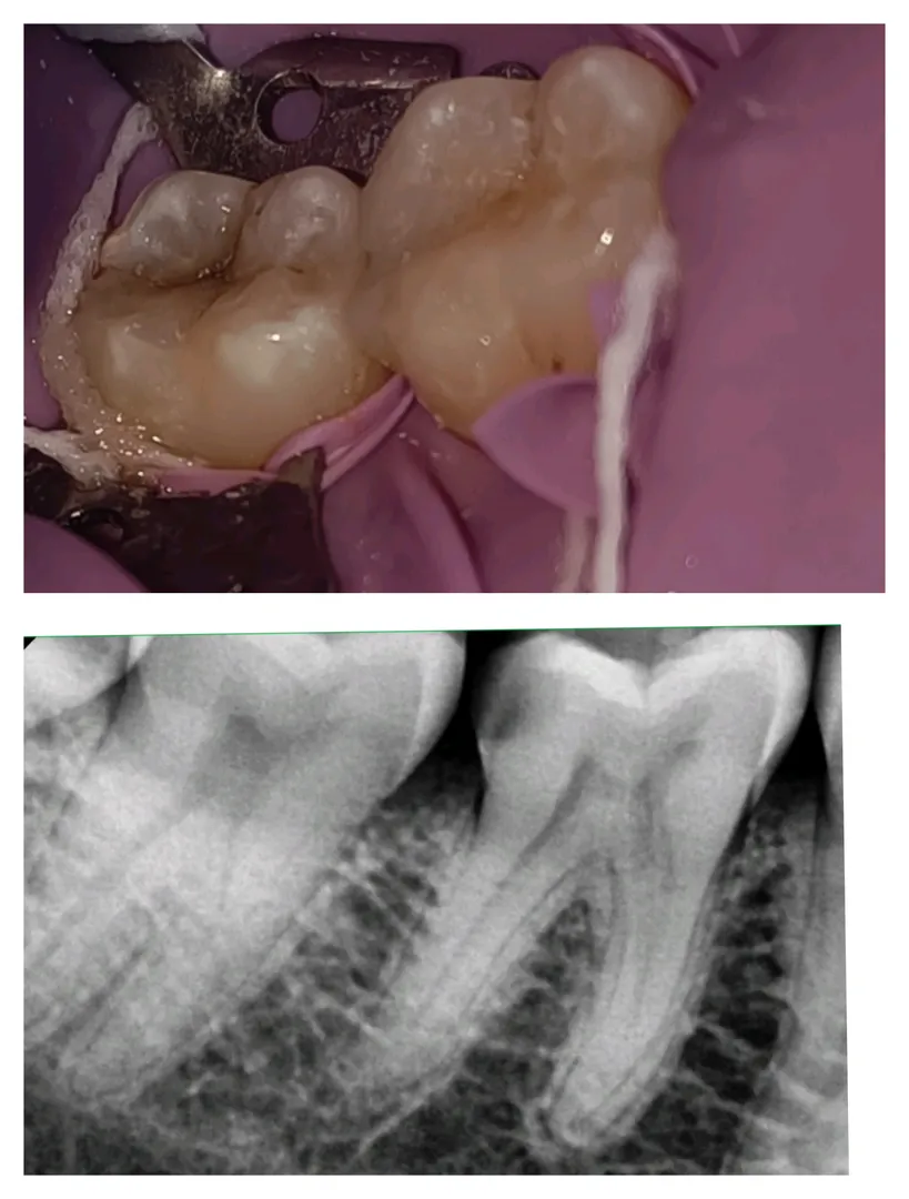 Is RCT Needed for Every Tooth?
Give a Second Chan...