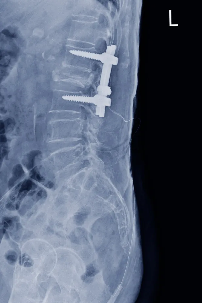 Spine Tumor Surgery in Pune: Precision and Expert ...