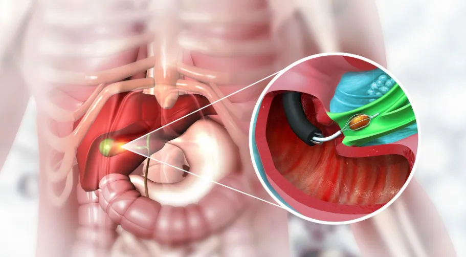 Robotic Cholecystectomy for Gallstones in Bangalor...
