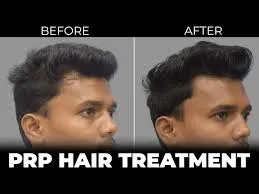 Hair PRP Treatment In Pitampura Revitalize Your Ha...