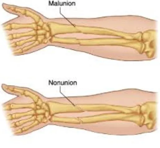 Nonunion Malunion Treatment in Pimpri-Chinchwad Fr...