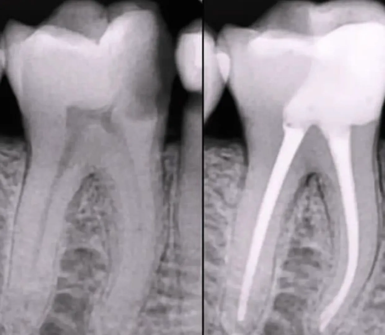 Root Canal Treatment in Anna Nagar – Pain-Free and...