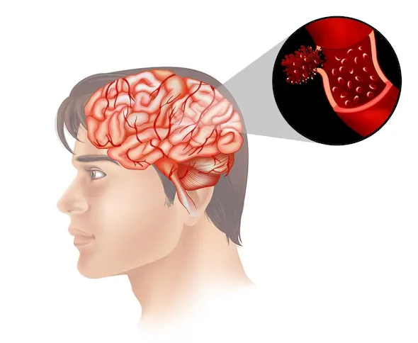 Head Injury and Brain Hemorrhage Treatment in Pune...