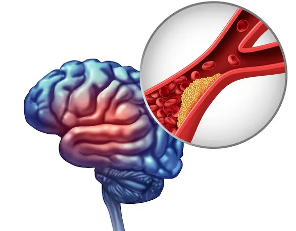 Brain Aneurysm Repair in Pune: Advanced Surgical E...