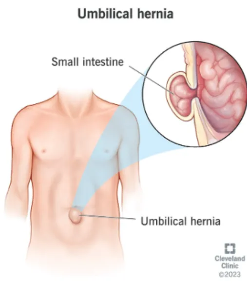 Best Umbilical Hernia Surgery in Nagpur Umbilical ...