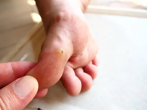 Diabetic Foot Ulcer Treatment – Specialized Care f...