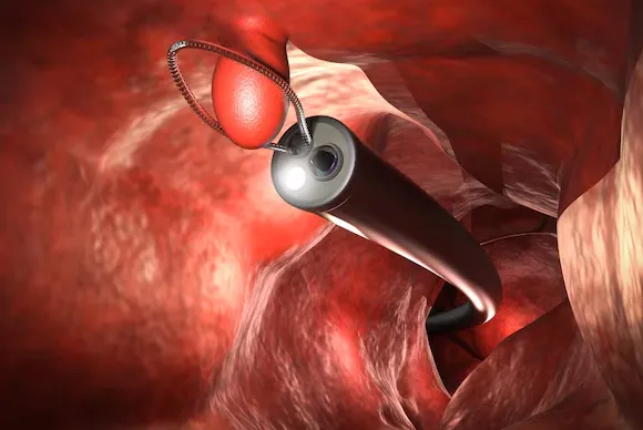 Best ESD (Endoscopic Submucosal Dissection) Specia...