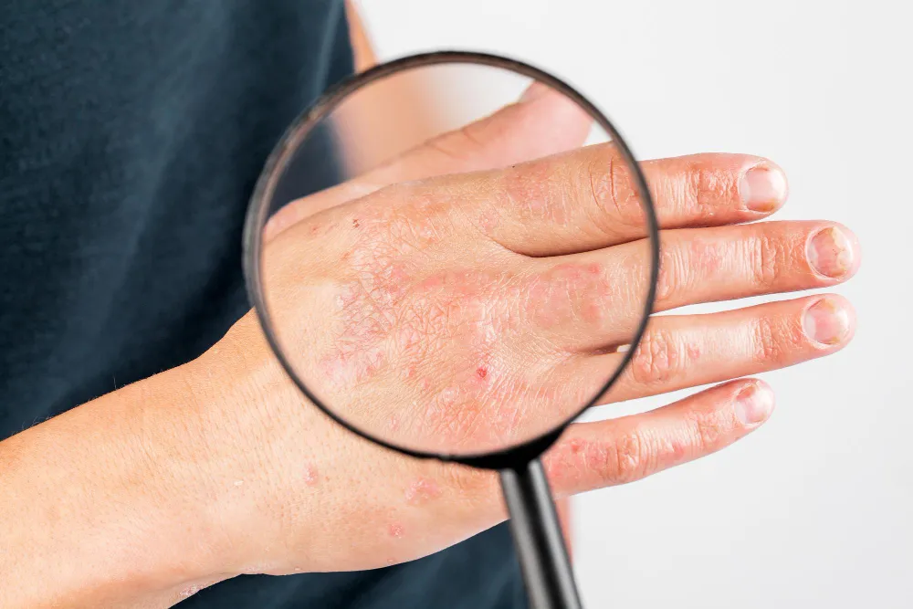 Best Homoeopathic Clinic for Psoriasis in Wagholi ...