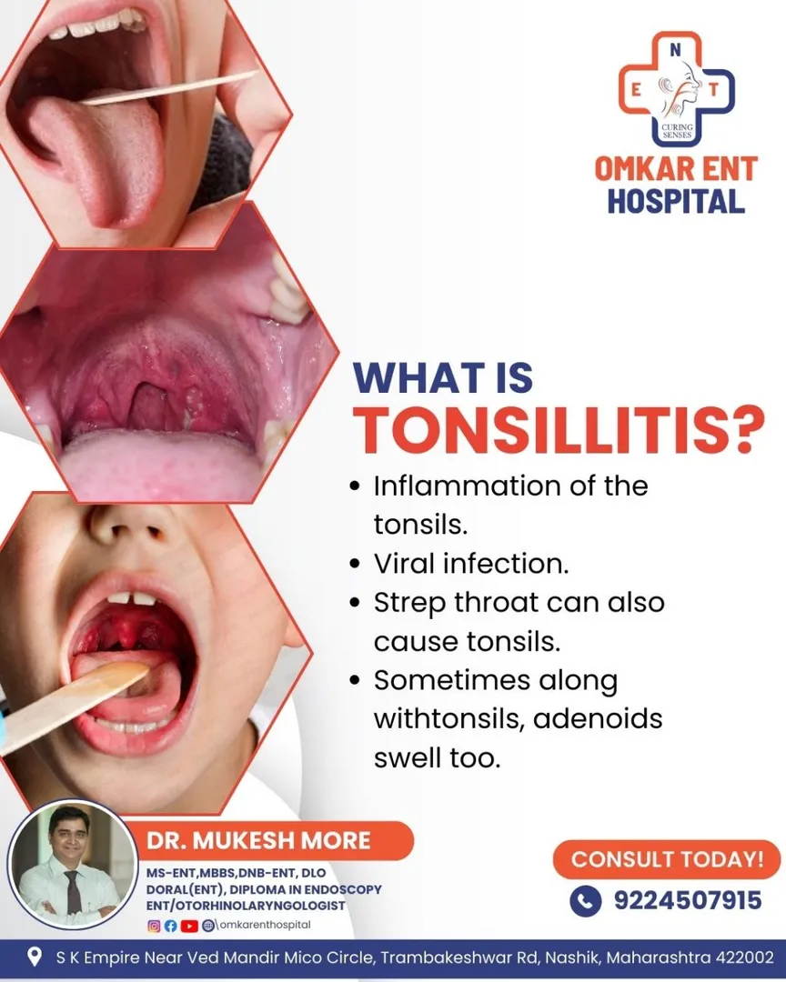 <b>Tonsil Surgery In Nashik</b><br><b>Tonsillitis<...