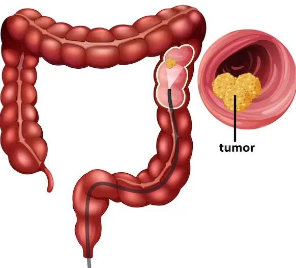 Robotic Colon Cancer Surgery in Bangalore – Precis...