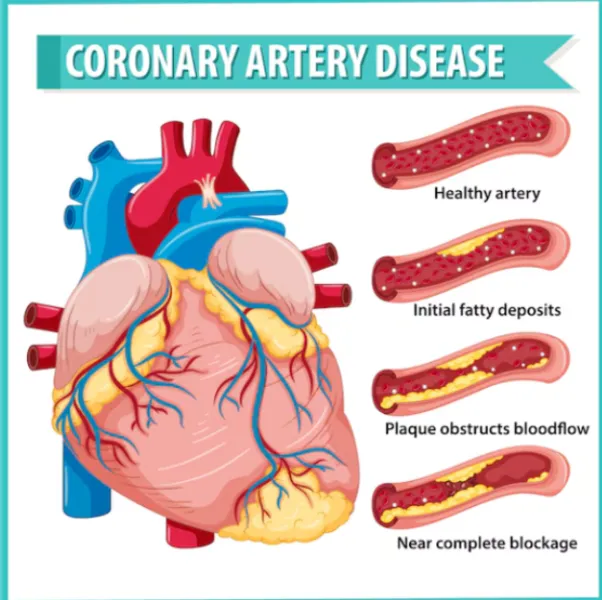 Coronary Artery Disease Specialist in Chennai – Ex...