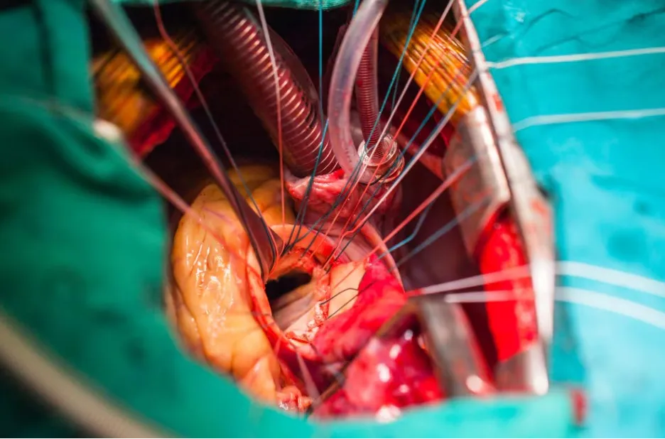 OPCAB in Nagpur Off-Pump Coronary Artery Bypass (O...