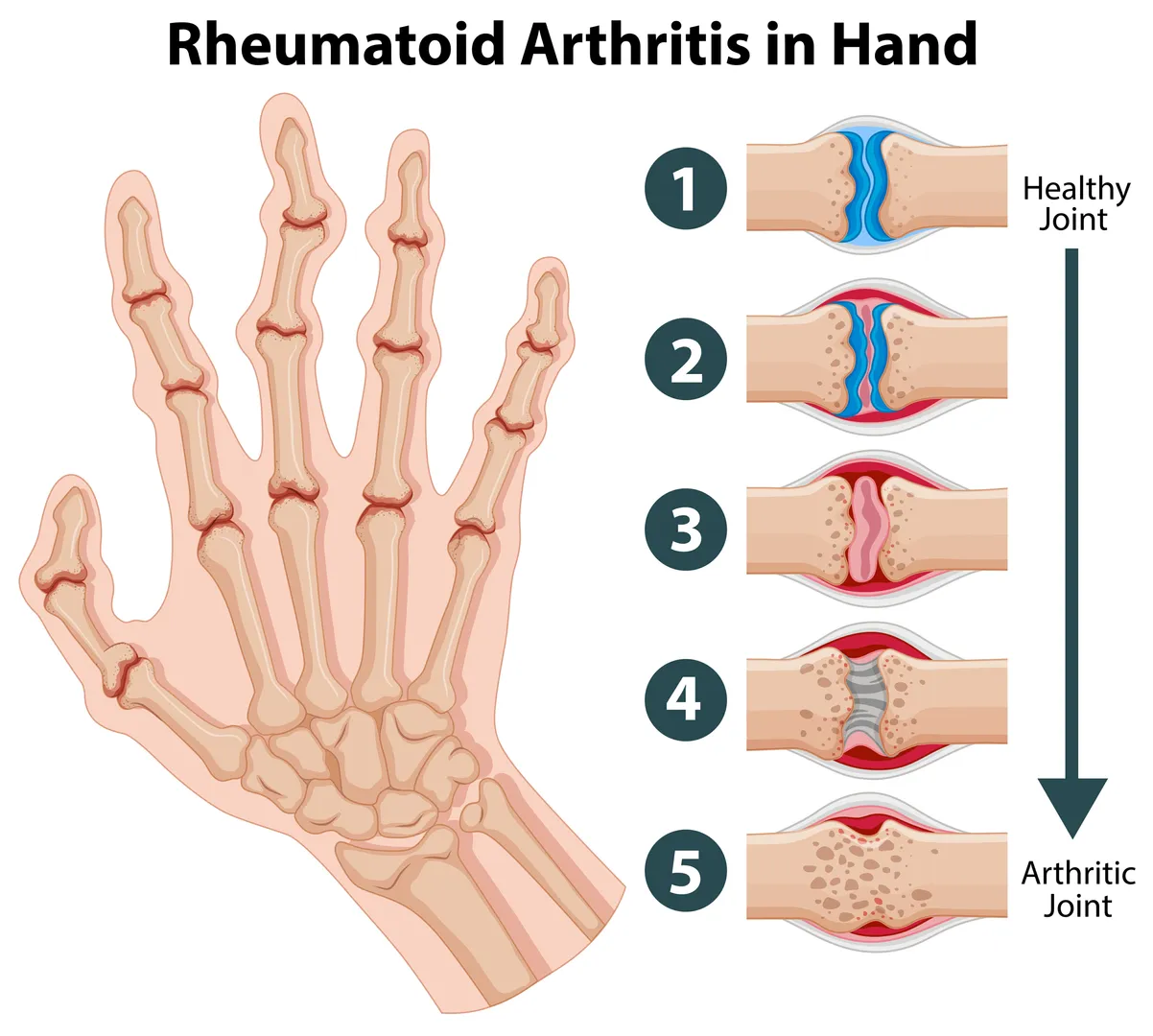 Best Homoeopathic Clinic for Rheumatoid Arthritis ...