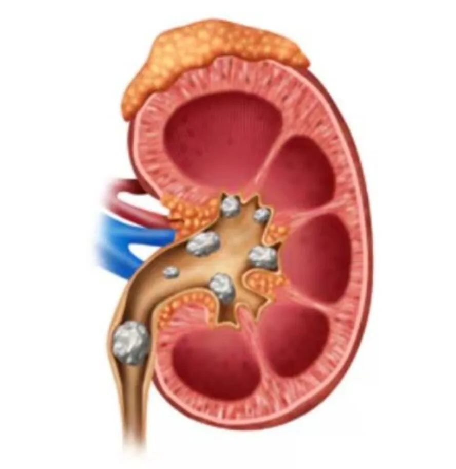 Kidney Stone Removal Treatment in Siddharth Nagar,...