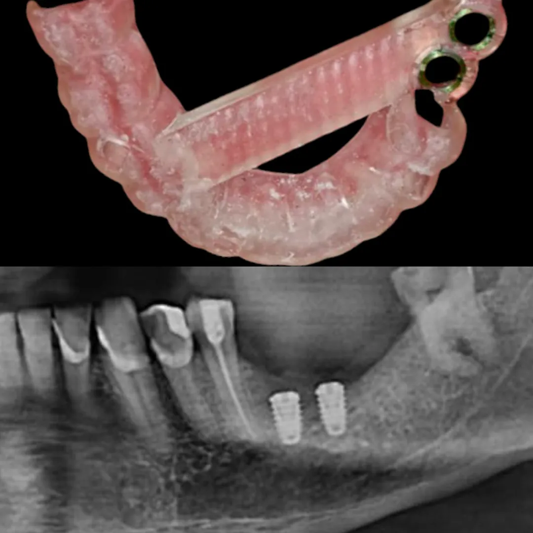 Placement of 2 short dental implants using 3D prin...