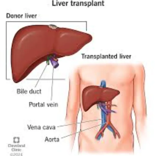 # Liver transplant center in dadar
# Liver transpl...