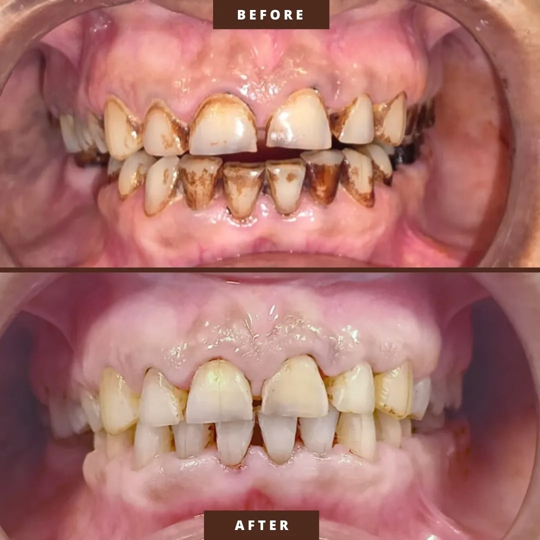 Teeth cleaning or teeth whitening?
If the discolo...