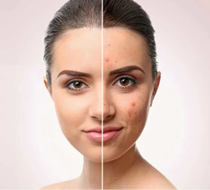 Acne Treatment in Dwarka
Are you struggling with ...
