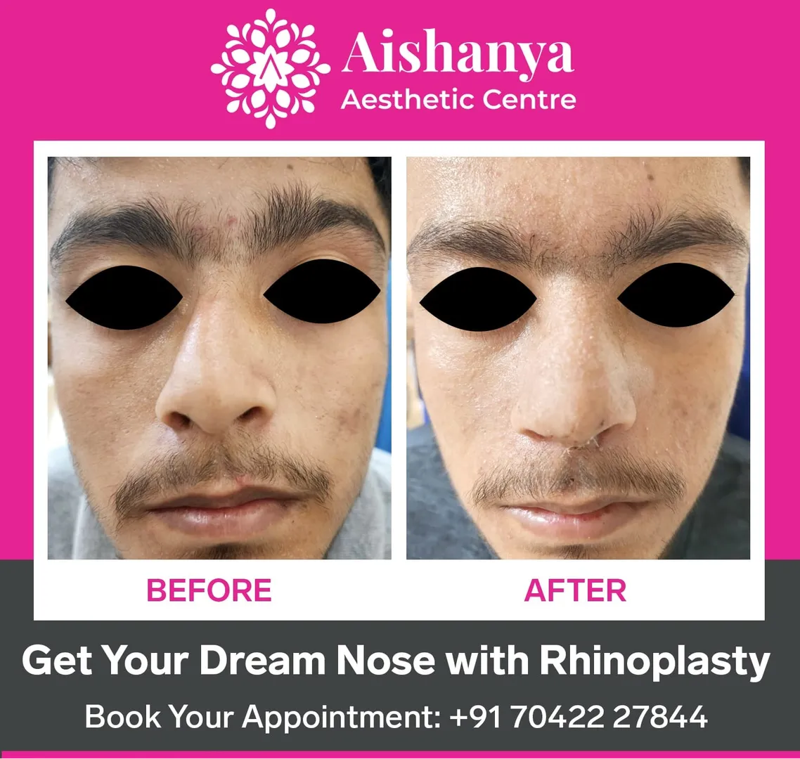 Rhinoplasty in Dwarka
Are you unhappy with the sh...