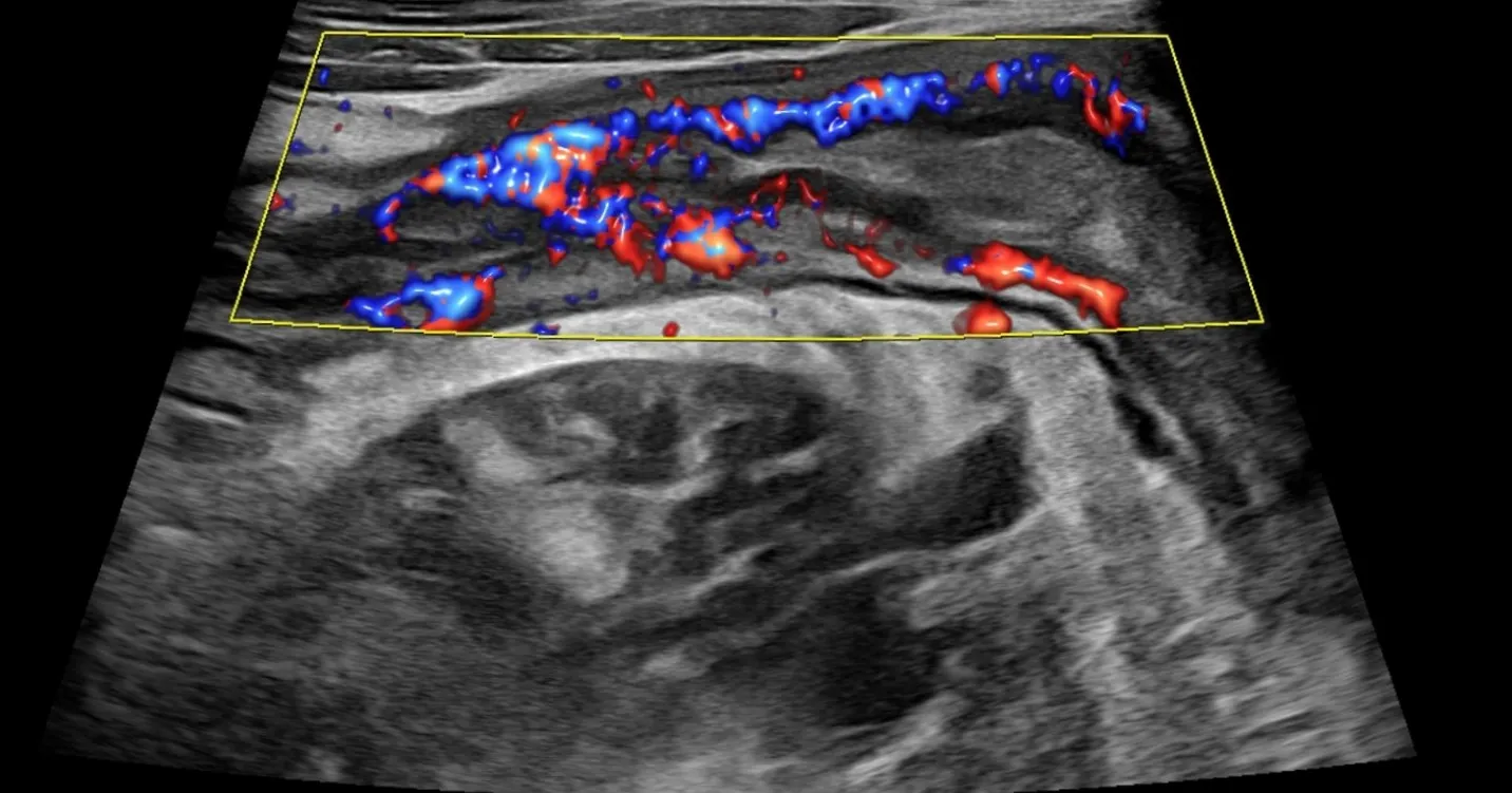 Intestinal ultrasound (IUS) Bowel ultrasound is in...