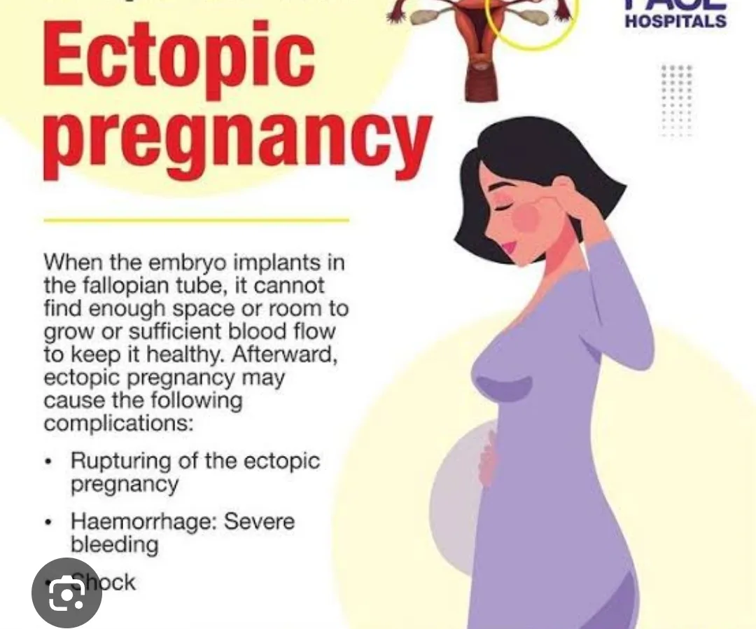 #Ectopic Pregnancy An ectopic pregnancy occurs whe...